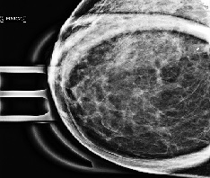 Diagnostic Mammography